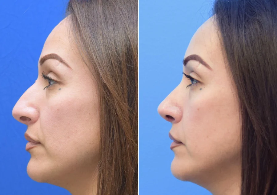 متى تظهر نتائج عملية تجميل الأنف؟