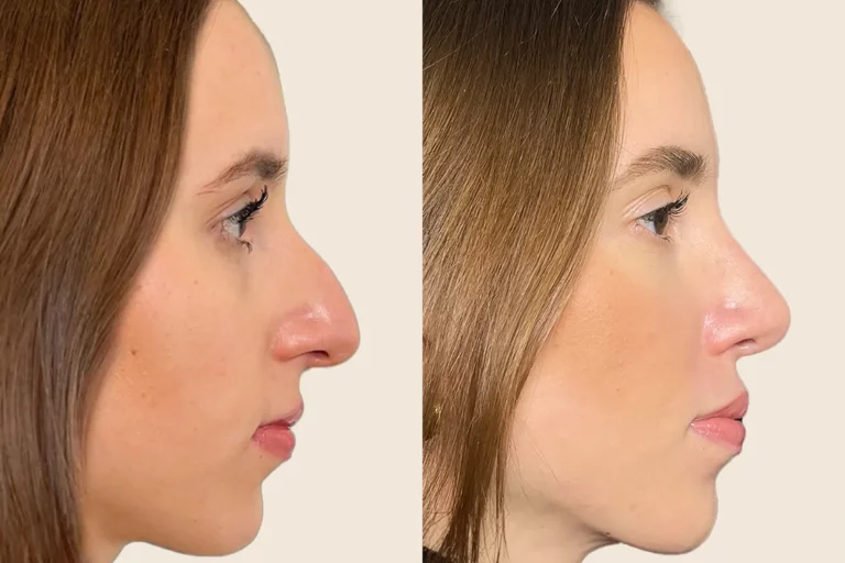نسبة نجاح عملية تجميل الأنف