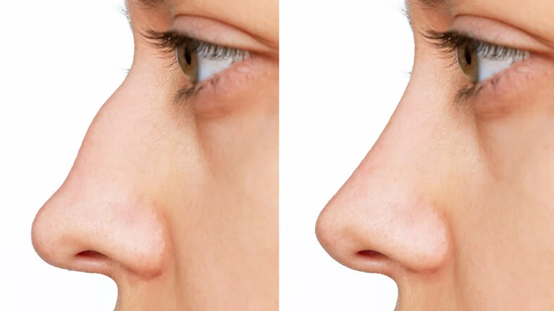 مخاطر عملية تجميل الأنف