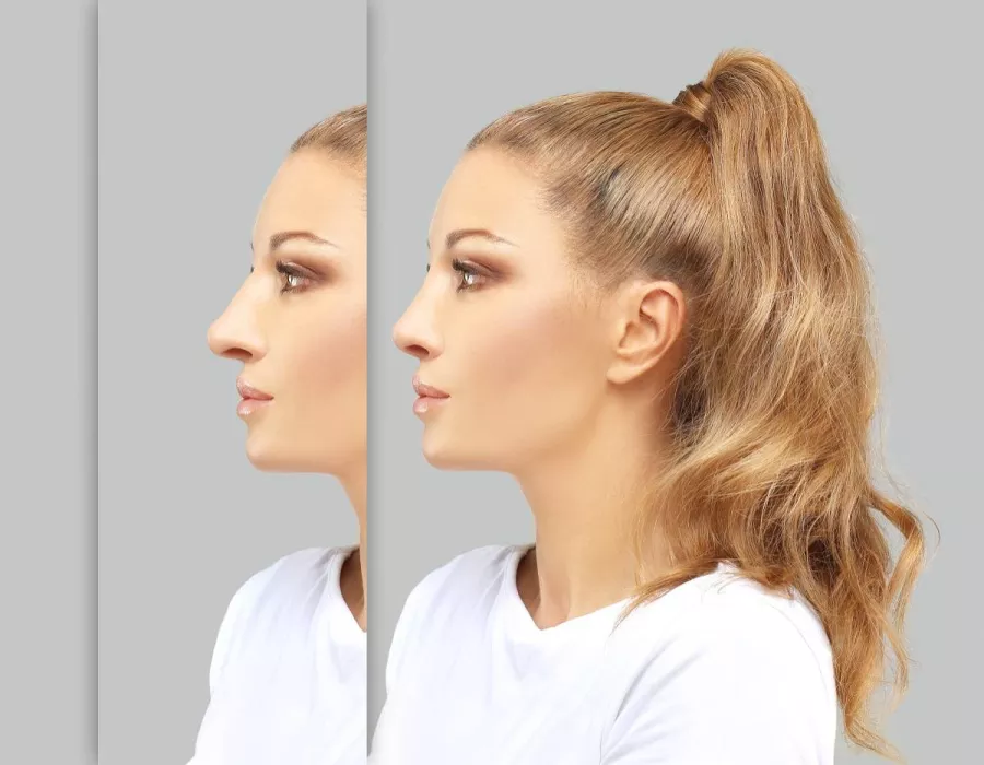 الفرق بين تجميل الأنف الجراحي وغير الجراحي