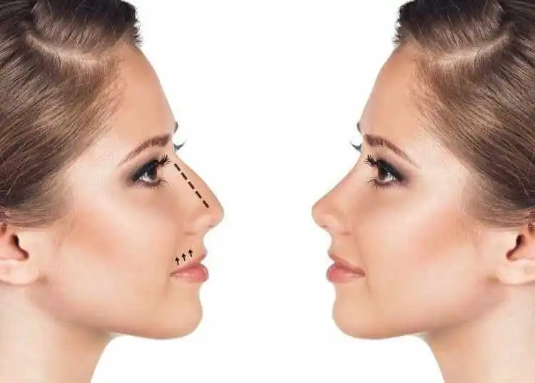 أفضل عيادات تجميل الأنف في السعودية